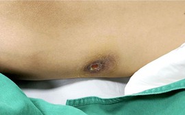 Bệnh Whitmore khiến nam 39 tuổi ở Thanh Hoá nguy kịch