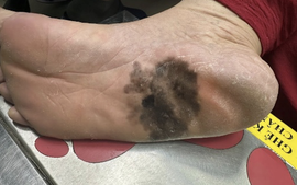 Đốm đen trên da có phải là dấu hiệu ung thư da?