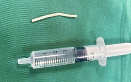 Que tránh thai “đi lạc” suốt 4 tháng trong bắp tay
