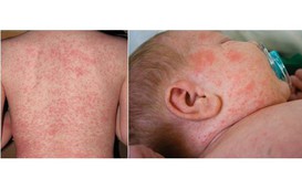 Bệnh sởi, rubella tăng, Bộ Y tế yêu cầu giám sát