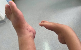 Bé gái đi được bằng chân sau 12 năm di chuyển bằng đầu gối