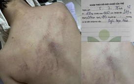 Vụ trẻ nghi bị cô giáo bạo hành: Cơ quan chức năng lên tiếng