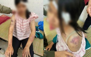 Thông tin mới vụ bé gái 13 tuổi bị tra khảo, đánh đập dã man, người chi chít vết thương
