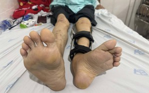 Người đàn ông bị bại liệt hơn 50 năm bỏ được chiếc giày đôn chân 6cm sau ca phẫu thuật
