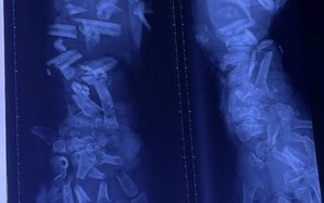 Tai nạn lao động thương tâm: Công nhân 37 tuổi bị máy nghiền vỏ dừa cán nát cánh tay