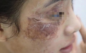 Cô gái bị tàn phá dung nhan vì bôi kem mua trên mạng