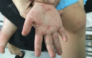 Làm gì để giảm nguy cơ tử vong và di chứng do bệnh tay chân miệng?