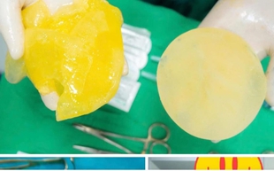 Phụ nữ đã "trùng tu" vòng 1 có nên chơi pickleball?