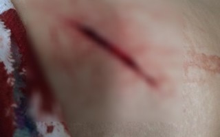 TP HCM: Cướp dùng dao cắt túi đeo, rạch đùi nạn nhân