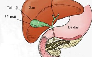 Kẻ thù của bệnh sỏi mật