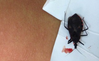 Hà Nội: Một bệnh nhân nhập viện do bọ xít hút máu cắn