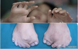 Phẫu thuật cho bé gái 15 ngón chân, 12 ngón tay