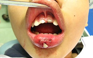 Tai nạn hy hữu: Răng môi lẫn lộn