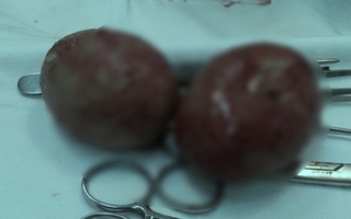 Bệnh nhân có hai cục sỏi bàng quang bằng củ khoai tây đã tỉnh
