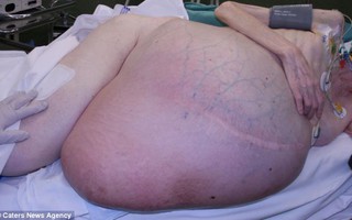 Phẫu thuật lấy khối u hơn 38 kg