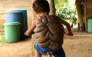 "Cậu bé rùa" mang nốt ruồi khổng lồ sau lưng