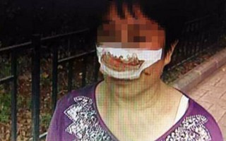 Trung Quốc: Cắn đứt mũi vợ do không nghe điện thoại