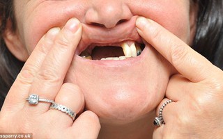 Mất hàm răng cửa vì tẩy trắng răng ở nha sĩ "dởm"