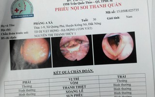 Khạc ra máu do bị đỉa chui vào cuống họng