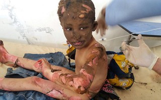 Chấn động em bé Napalm Syria