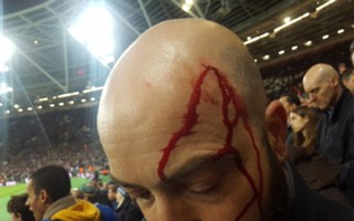 Fan Chelsea bị đánh đổ máu ở trận thua West Ham