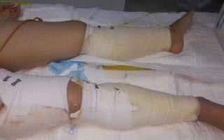 Cô gái 18 tuổi vụ sập nhà ở Cửa Bắc không phải cưa chân