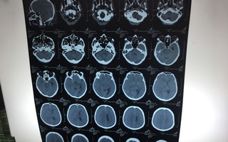Té sau 3 tháng mới biết chấn thương sọ não