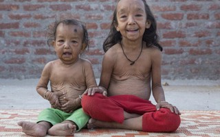Ấn Độ: Hai chị em ruột cùng bị lão hóa