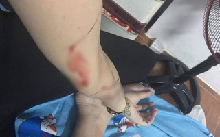 Thực hư thiếu nữ bị gã biến thái rạch tay ở Phú Nhuận