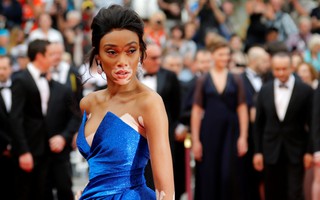 Người mẫu bạch biến tự tin khoe dáng tại Cannes 70