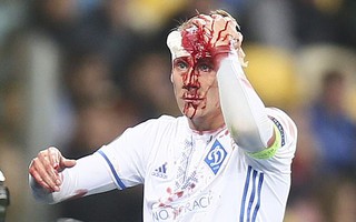 Không chiến nảy lửa, sao Dynamo Kiev vỡ đầu