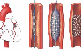 Stent thế hệ mới cho bệnh nhân mạch vành