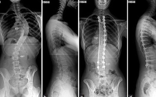Dễ bỏ qua bệnh lý cong vẹo cột sống ở trẻ