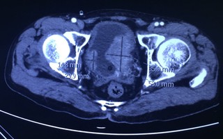 Tái tạo bàng quang bị ung thư bằng ruột non