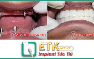 Cấy ghép răng Implant ETK Active ở đâu?