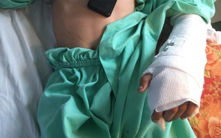 Một cậu bé 14 tuổi bị máy cắt lìa bàn tay