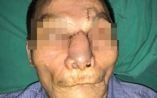 Một nam giới bị khoét sạch mũi, má vì ung thư da