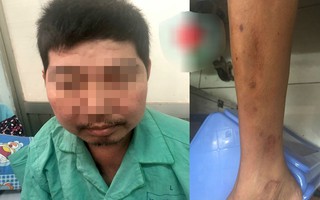 Uống thuốc Đông y "ngậm" corticoid, người đàn ông "to không đều"