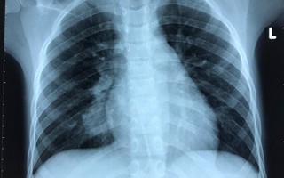 Qua 3 bệnh viện, ca bệnh phổi hiếm gặp được cứu