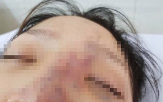 Một nữ sinh có nguy cơ mù mắt vì tiêm filler