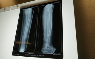Yêu cầu "kỳ lạ", người phụ nữ gãy chân bị nhiều bệnh viện từ chối