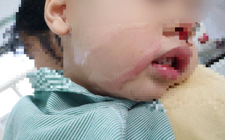 Nhỏ nhầm axit để rửa mũi khiến bé trai bị bỏng nặng