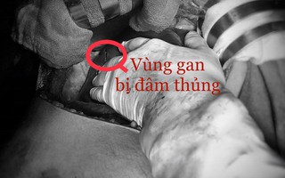 Cứu sống bệnh nhân bị đâm thủng tim, gan