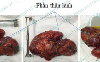 Lấy được loại u thận 3,5 kg thường gặp ở phái nữ