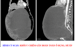 Lấy khối u nặng đến 30 kg trong ổ bụng người phụ nữ  ra ngoài