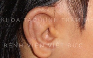 "Chế" vành tai cho bé 6 tuổi bằng sụn nhân tạo