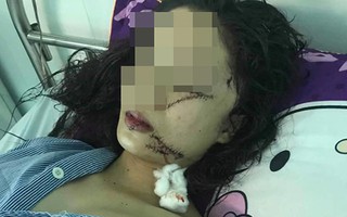Vụ cô gái xinh đẹp 18 tuổi bị rạch mặt: Công an thông tin bất ngờ về nguyên nhân