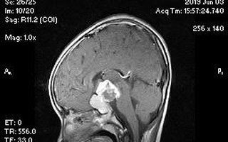 Kỳ lạ bé gái mắc chứng hay nhớ, hay quên