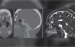 Bệnh nhân rỉ dịch não tủy vì xét nghiệm Covid-19 bằng tăm bông