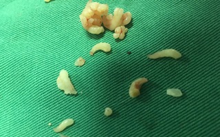 Lấy gần 20 chiếc răng cho bé 12 tuổi bị khối u răng hiếm gặp